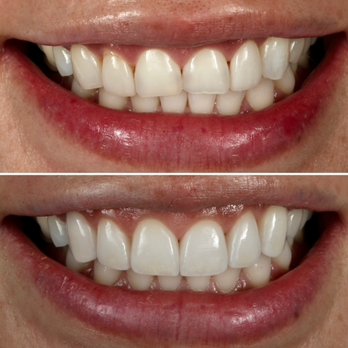 Brookline Dental Esthetics - Smile Makeover with Porcelain Veneers - General Dentistry Near Me - Brookline, Massachusetts Brookline Dental Esthetics - Smile Makeover with Porcelain Veneers - General Dentistry Near Me - Brookline, Massachusetts