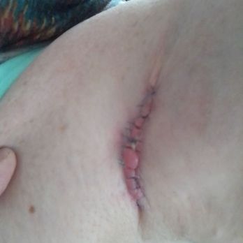 Forefront Dermatology Manitowoc, WI - Sutures after cyst removal under arm from Dr Azam Qureshi - Dermatologists Near Me - Manitowoc, Wisconsin Forefront Dermatology Manitowoc, WI - Sutures after cyst removal under arm from Dr Azam Qureshi - Dermatologists Near Me - Manitowoc, Wisconsin