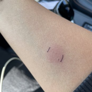 WellnessMart, MD - There is no induration, only erythema. - Laboratory Testing Near Me - Long Beach, California WellnessMart, MD - There is no induration, only erythema. - Laboratory Testing Near Me - Long Beach, California
