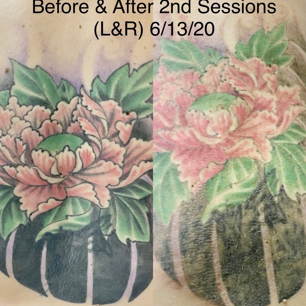 Removery Tattoo Removal & Fading - Very impressed that this much is gone after just TWO sessions! Can't wait to have this gone! - Tattoo Removal Near Me - Round Rock, Texas Removery Tattoo Removal & Fading - Very impressed that this much is gone after just TWO sessions! Can't wait to have this gone! - Tattoo Removal Near Me - Round Rock, Texas