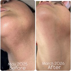 Silky Touch - Electrolysis of the chin and neck after 10 treatments