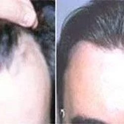 Irwin B Simon, MD - Dr. Simon of Vegas Valley Hair Restoration - Before and After photo