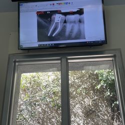 RootVision Endo - X-ray before and after