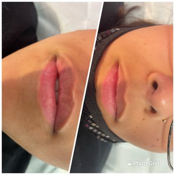 BabyCakez - Hyaluron Pen Lip Fillers - Teeth Whitening Near Me - Antioch, California BabyCakez - Hyaluron Pen Lip Fillers - Teeth Whitening Near Me - Antioch, California