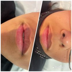 BabyCakez - Hyaluron Pen Lip Fillers