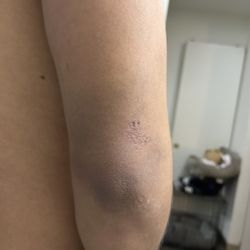 Providence Bridgeport Immediate Care - Pretty sure it's a tear in my tricep after the doctor said I was fine to work the next day! Thanks doctor Frances Katherine Dawson, MD!