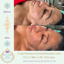 Dermal Infusion with PLLA (Poly L Lactic Acid filler) Adipose and Mesenchymal Stem Cells & RF Therapy + Ultrasound & Cold Atmospheric Plasma