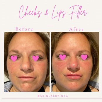 Skin Lab by Inga RN - Client transformation. Botox,Juvederm Voluma to cheeks,Juvederm Volbella to lips. - Medical Spas Near Me - Johns Creek, Georgia Skin Lab by Inga RN - Client transformation. Botox,Juvederm Voluma to cheeks,Juvederm Volbella to lips. - Medical Spas Near Me - Johns Creek, Georgia