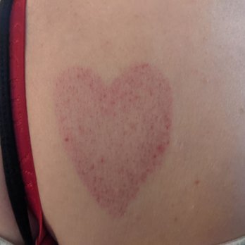 Vitality Vibe Wellness - Heart shaped cup marks post massage - Massage Near Me - Manassas, Virginia Vitality Vibe Wellness - Heart shaped cup marks post massage - Massage Near Me - Manassas, Virginia
