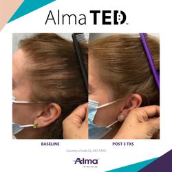 San Jose Medical Spa - Alma TED Hair Restoration - NO Pain NO Shedding NO needles - Proven RESULTS to help with hair loss