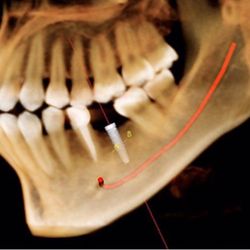 Kay Dental Care - 3D x-Ray(CBCT). Low radiation Green CT. For better diagnosis & treatment planning including computer guided implant procedures.