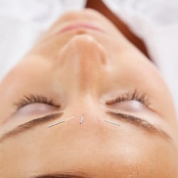CHA Acupuncture & Herb - Acupuncture Face-lift