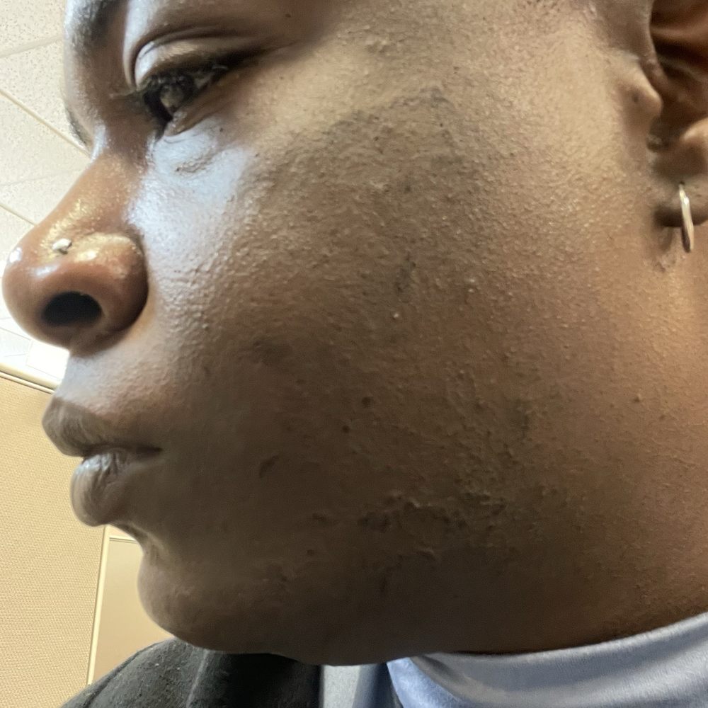 Ideal Image Vancouver - Cheek, Chin and Neck Burns post procedure - Laser Hair Removal Near Me - Vancouver, Washington Ideal Image Vancouver - Cheek, Chin and Neck Burns post procedure - Laser Hair Removal Near Me - Vancouver, Washington