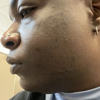 Ideal Image Vancouver - Cheek, Chin and Neck Burns post procedure - Laser Hair Removal Near Me - Vancouver, Washington