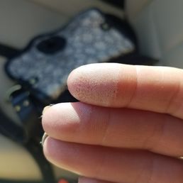 Chemical Burns from being instructed to dip my fingers in pure acetonw Chemical Burns from being instructed to dip my fingers in pure acetonw