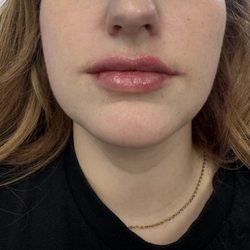 Glowing Complexions - Lip filler can increase the volume and shape in the lips