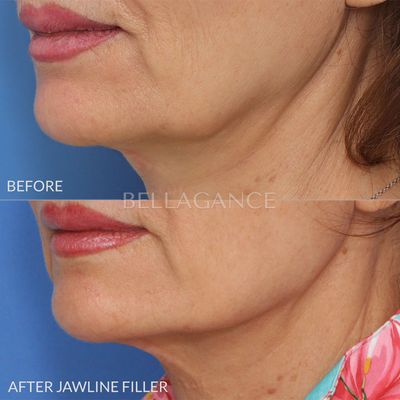 Jawline filler - Filler treatment of the jawline to help create jawline definition and reduce the appearance of the jowls. Jawline filler - Filler treatment of the jawline to help create jawline definition and reduce the appearance of the jowls.