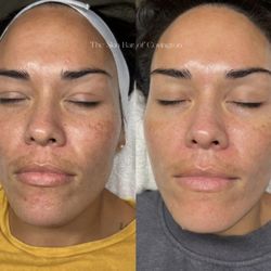 The Skin Bar - BioRePeel series!