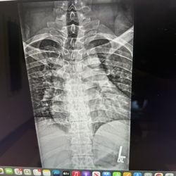Clearview Chiropractic - Curved spine he adjusted.