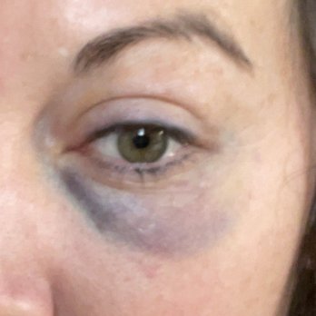 Beautify Spa - Black eye from Botox! - Skin Care Near Me - Scottsdale, Arizona Beautify Spa - Black eye from Botox! - Skin Care Near Me - Scottsdale, Arizona