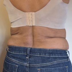 Virginia Institute of Plastic Surgery - Large amount of residual fat in flanks and lower back. cost$9,500.00. This is the results after his 2nd go at it.