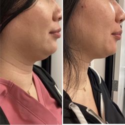 Radiant Aesthetics - Before and after one Kybella treatment