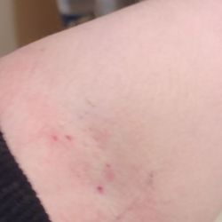 All Family Dental & Braces - Arm 1 scars