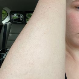 The splotchy "dark" spray tan after being rinsed off and kept on longer than the recommended time The splotchy "dark" spray tan after being rinsed off and kept on longer than the recommended time