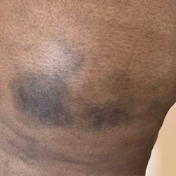 Bruising!! Beware!
