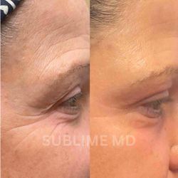 Sublime MD - Fine line/Wrinkle improvement around the eyes after one treatment of CO2 resurfacing