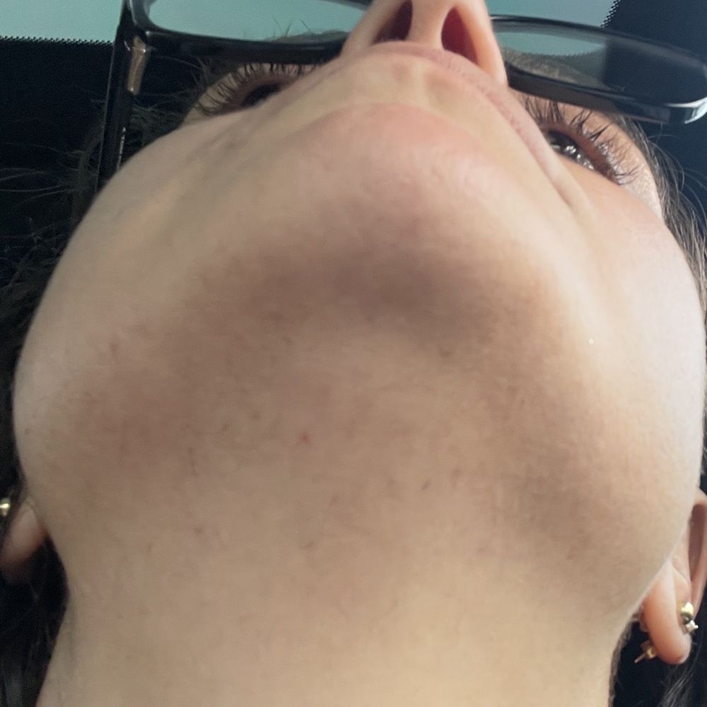 Electrolysis by Anna - 1 month of growth - Hair Removal Near Me - Glendale , California