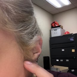 bleached hair that wasn't toned properly and just left. You can see this all around my face/hairline bleached hair that wasn't toned properly and just left. You can see this all around my face/hairline