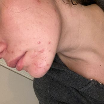 PurefectionLA - before - Estheticians Near Me - Toluca Lake, California