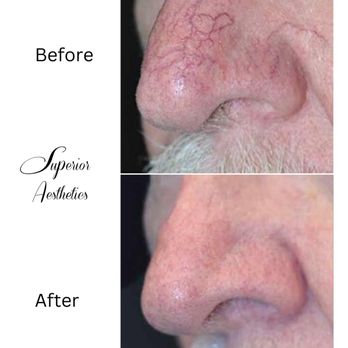 Superior Aesthetics - Laser Vein Therapy in Marquette - Medical Spas Near Me - Marquette, Michigan Superior Aesthetics - Laser Vein Therapy in Marquette - Medical Spas Near Me - Marquette, Michigan