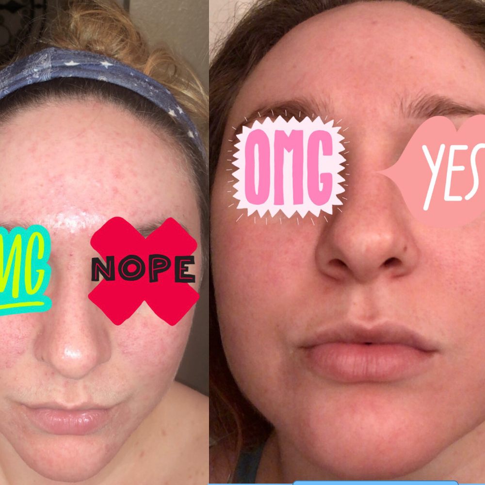 From the beginning all the way to now. My skin has drastically changed. Sensitive, oily, acne prone.No hope. I feel like a brand new person! From the beginning all the way to now. My skin has drastically changed. Sensitive, oily, acne prone.No hope. I feel like a brand new person!