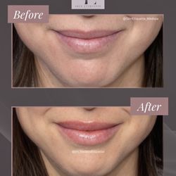 Skin Etiquette Medspa - Subtle enhancement for her first lip filler