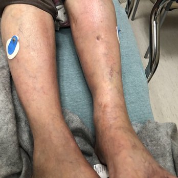 Park Avenue - Hope Escamilla legs with cellulitis was on wheelchair at the Park Avenue Health and Wellness facility again was sedated - Rehabilitation Center Near Me - Pomona, California