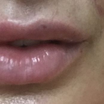 Ageless Las Vegas - Right after lip flip - Medical Spas Near Me - Las Vegas, Nevada Ageless Las Vegas - Right after lip flip - Medical Spas Near Me - Las Vegas, Nevada