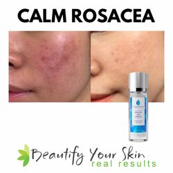 Beautify Your Skin - Rosacea products available. We teach you how to calm the skin.