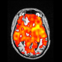 Sheldon Jordan, MD - Arterial Spin Labeling (ASL) MRI scan of patient with early dementia showing signal drop out in posterior aspects of brain