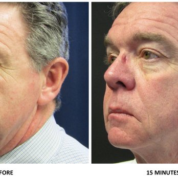 Moore Center Med Spa - Dr. Moore before and after liquid facelift. - Medical Spas Near Me - Athens, Georgia Moore Center Med Spa - Dr. Moore before and after liquid facelift. - Medical Spas Near Me - Athens, Georgia