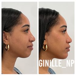 Ginille Beauty Aesthetics - Cheeks and chin filler