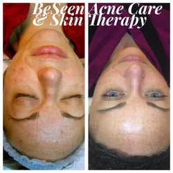 Beseen Acne Care and Skin Therapy