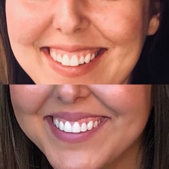 Bright Smiles Dental Studio - Before and after veneers on lateral incisors - General Dentistry Near Me - Glendale, California