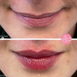 My Happy Place - Not sure you want lip filler injections? Check out this 100% NATURAL lip transformation with her own PRF I extracted from her own blood.