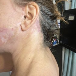 Kasden Plastic Surgery - Left cheek and behind Ear