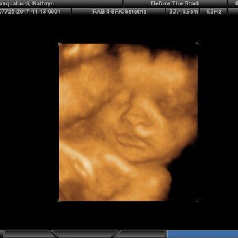 Before the Stork 4D - Ultrasound Imaging Centers Near Me - Anaheim, California