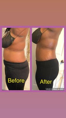 Cavitation and Skin tightening - (6) 360 session on back and stomach area. Includes Cavitation, skin tightening, and laser lipo. Cavitation and Skin tightening - (6) 360 session on back and stomach area. Includes Cavitation, skin tightening, and laser lipo.