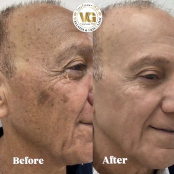 VitaGlowMD - Sun Damage , Age Spot laser Treatment by Dr Foroozan Famoori - Medical Spas Near Me - San Jose, California VitaGlowMD - Sun Damage , Age Spot laser Treatment by Dr Foroozan Famoori - Medical Spas Near Me - San Jose, California