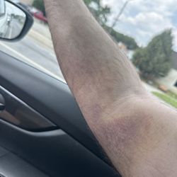 BioLife Plasma Services - My super bruised arm from getting a hematoma at BioLife